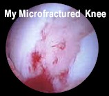my microfractured knee