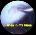 partee in my knee